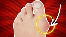 How To Fix Bunions Without Surgery