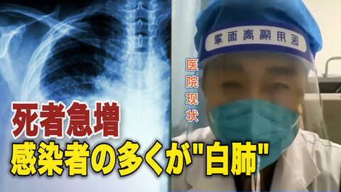 中国の感染者急増 多くの若者も「白肺」に