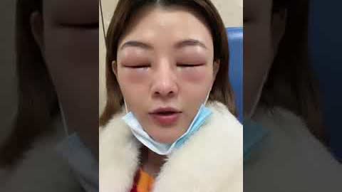 2月3日，女子吃布洛芬過敏，眼睛腫的只剩一條縫。【 #shorts 】| #大紀元新聞網