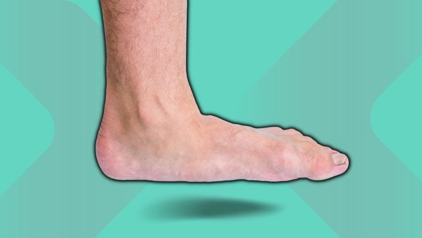 How To Get Rid Of Flat Feet