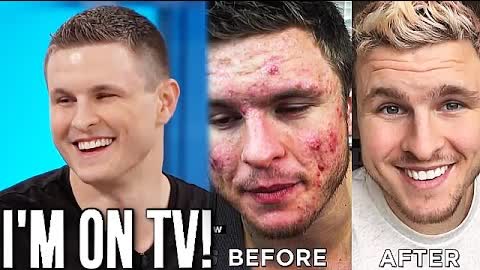 My Acne Story On National TV! (THE DOCTORS - OFFICIAL VIDEO)