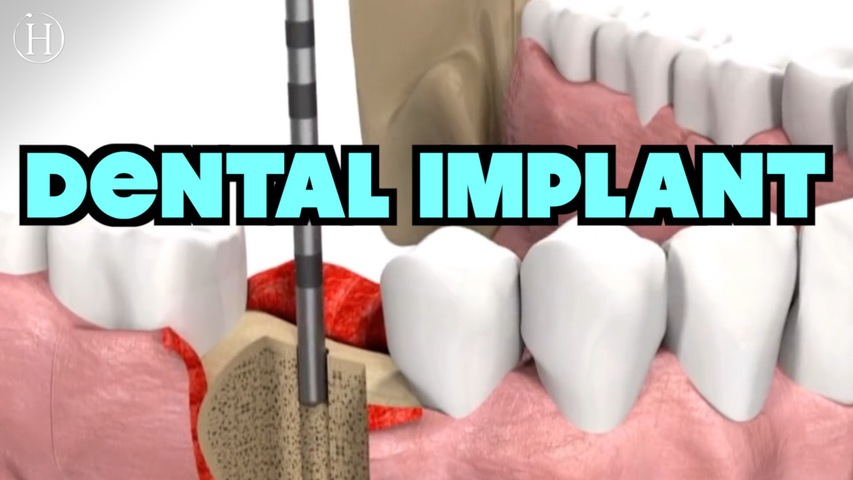 New Dental Implant Process | Humanity Life