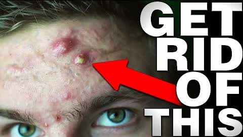 EXACTLY What To Do With A BIG Zit or Cyst! (From Experience)