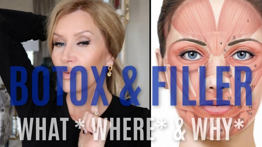 Filler & Botox~What I Have and Why