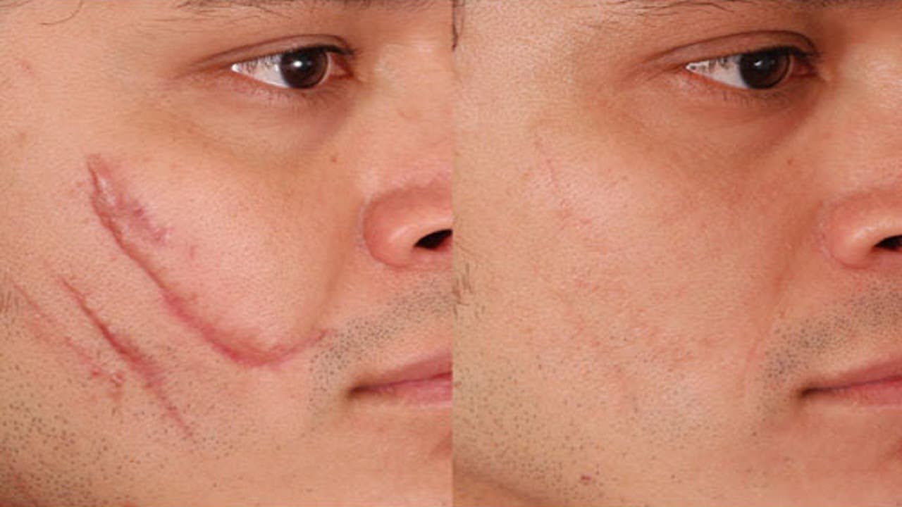 Best Way To Remove Facial Scars Naturally