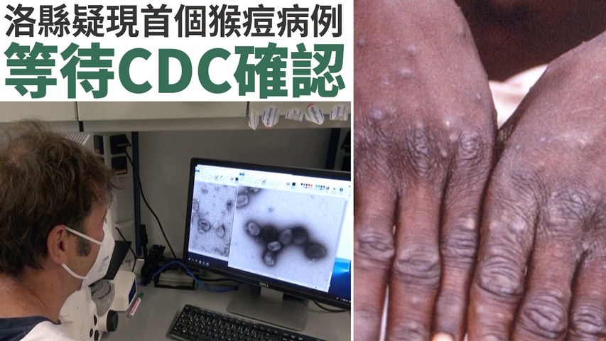 洛縣疑現首個猴痘病例 等待CDC確認｜今日加州