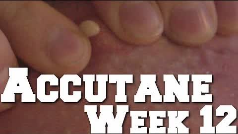 Giant Cyst Squirt & Week 12 of Accutane