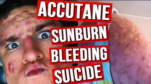 Why You Should NOT Take Accutane (From Experience)