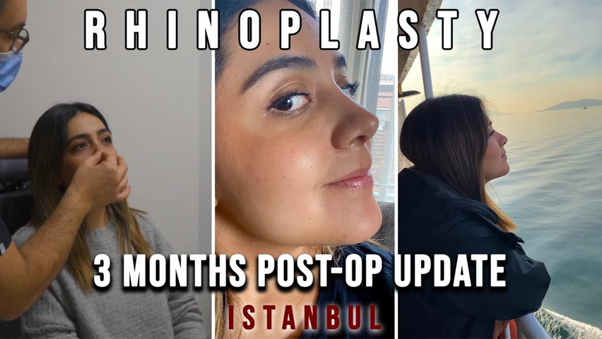 Rhinoplasty in Istanbul | 3 Months After the Surgery