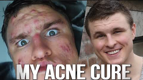 How I ELIMINATED My Acne