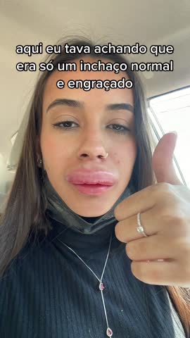 Brasileña se rellena los labios y termina con terrible reacción alérgica