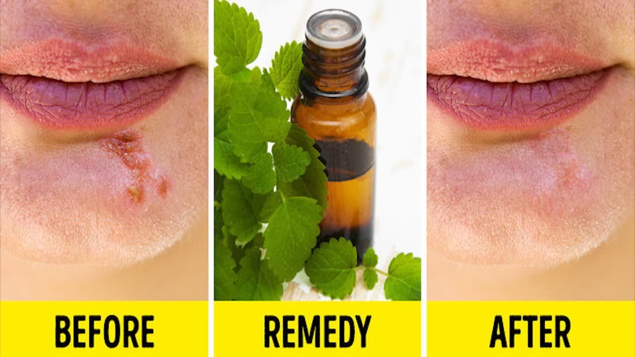 8 Ways To Get Rid of A Cold Sore in a Flash