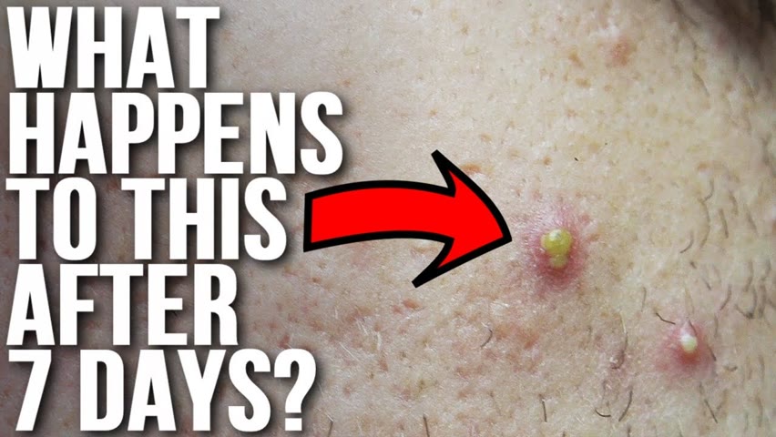 Don't Touch Your Acne & See What Happens!