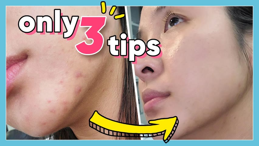 It's Im-PORE-tant: 3 QUICK & SIMPLE ways to get rid of pimples!