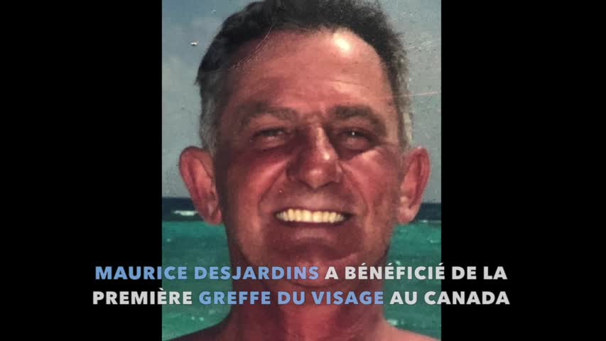 Montréal : la toute première greffe de visage au Canada est un succès - un Québécois peut commencer une nouvelle vie
