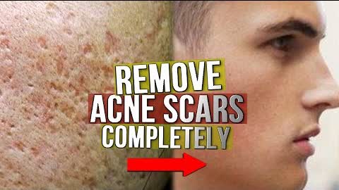 EXACTLY What To Do With Acne Scarring! (From Experience)